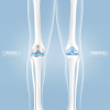 Partial vs. Total Knee Replacement – What’s Right for You?