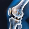 Smart Implants and Wearables – The Future of Joint Replacement
