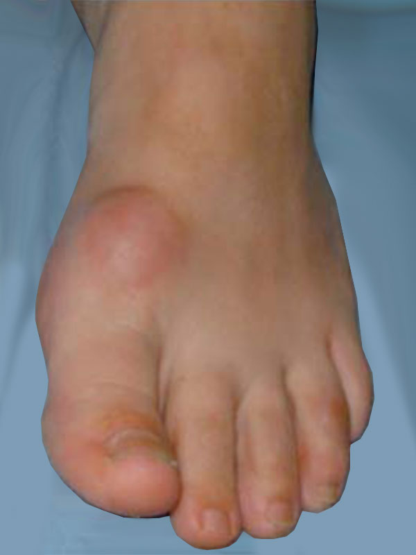 Hallux rigidus (HR) refers to stiffness (rigidus) of the joint at the base ...
