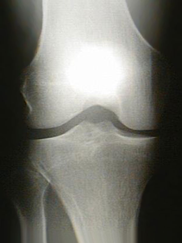 Трещина в коленной. Гонартроз коленного сустава 2. Посттравматический деформирующий гонартроз. Деформирующий гонартроз коленного.